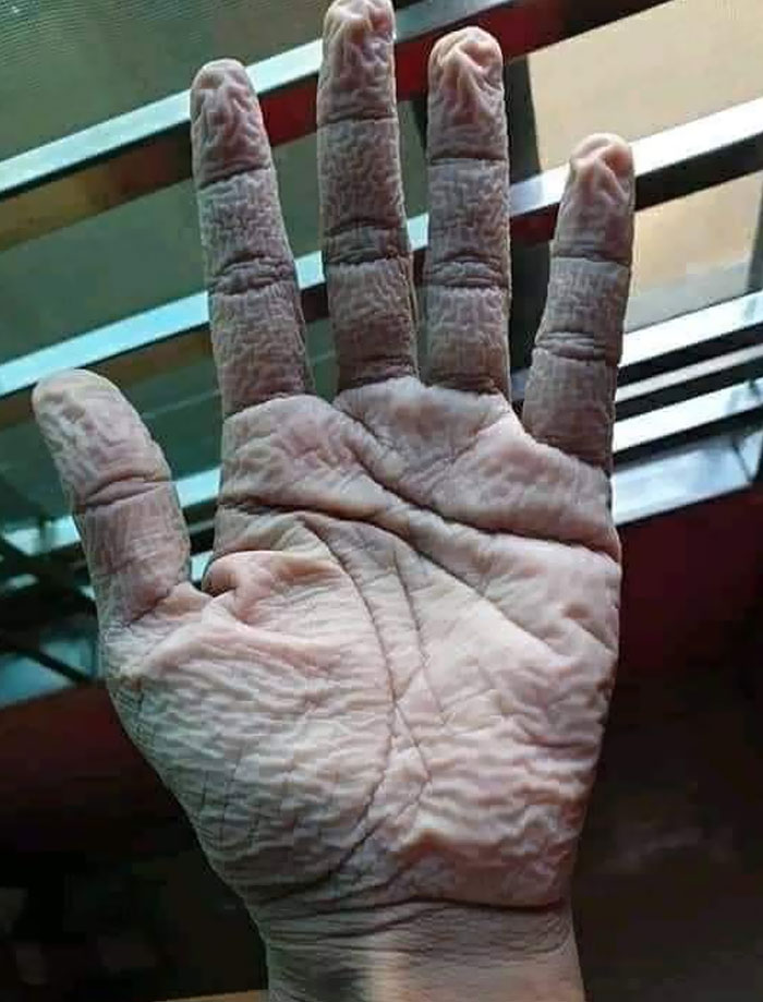 Así es la mano de un médico después de quitarse el traje y los guantes médicos de protección tras 10 horas de servicio