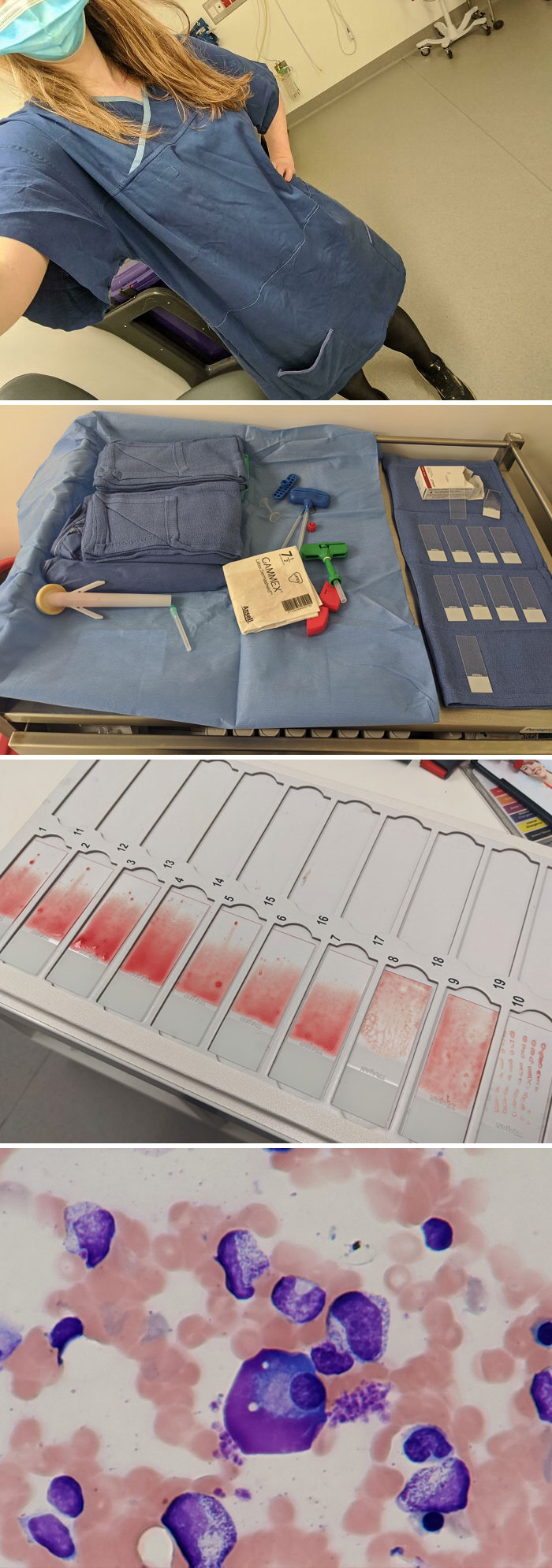 A Day In The Life Of A Hematology Registrar. And How To Do A Bone Marrow Biopsy