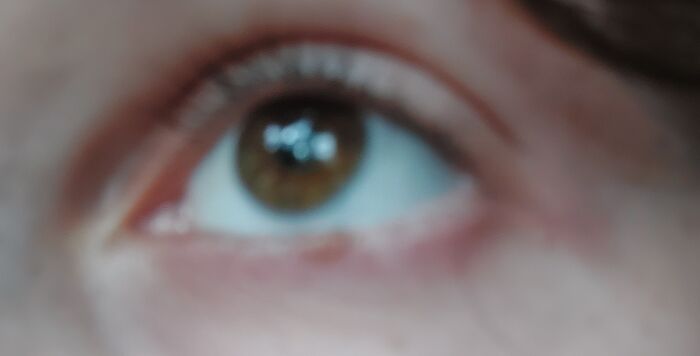 Best Picture I Have Of My Eye. I Look A Bit Less Dead In This One!