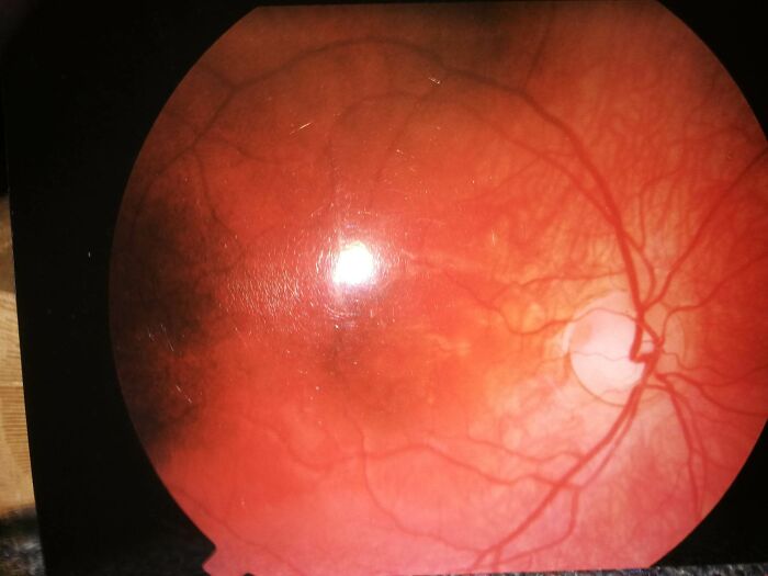 Does This Count? Picture Of My Retina From When I Was Younger