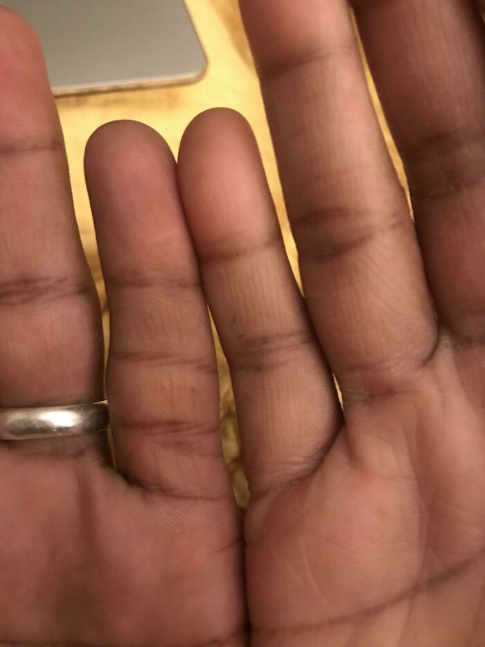 Today I Realized That My Husband Has An Extra Section Of Pinky (Mine For Comparison)