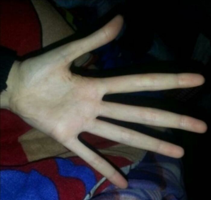 Here Are My Marfan's Syndrome Hands
