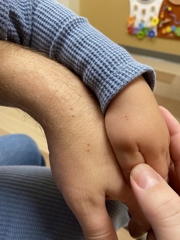 Mi hijo y yo tenemos la misma mancha de 2 pecas en las manos
