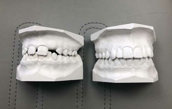 8 años de trabajo dental para corregir la falta de un diente, la comparación del principio y del final 