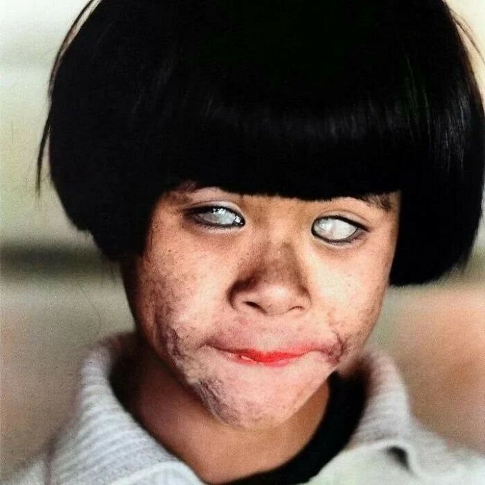 The Eyes That Saw The End Of The World, 1945 A Picture Of A Blind Japanese Girl Who Lost Her Sight Due To Witnessing The Atomic Bomb Attack On Hiroshima On August 6th, 1945