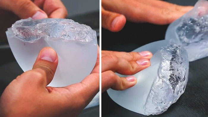 What's Inside The Breast Implant?