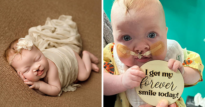 The Heart-Warming Story Of One Photograph: An Image Of A Baby With A Cleft Lip, Making Her Story Go Viral