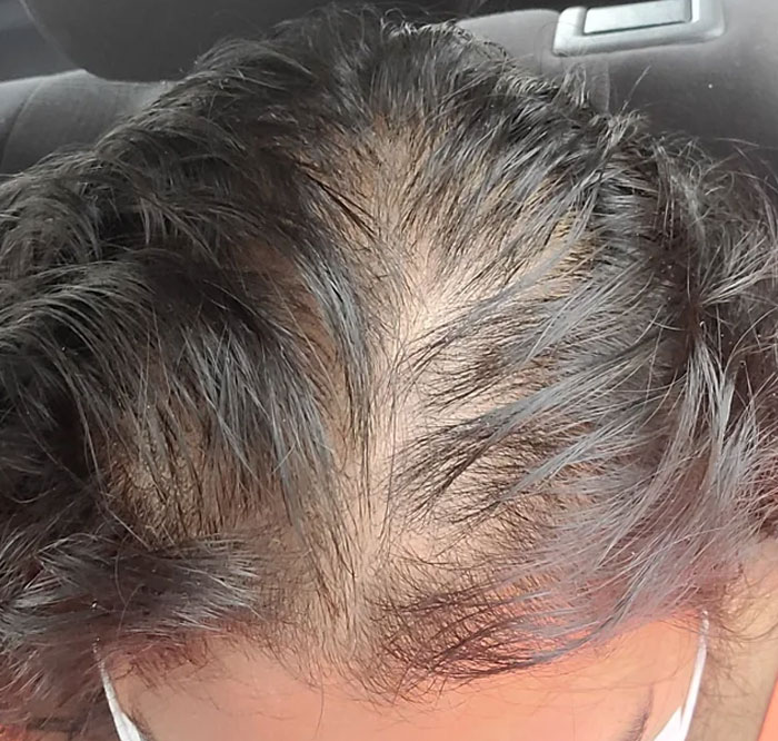 Patient Calls This Nurse's Wig "Unprofessional", Regrets It When She Takes It Off