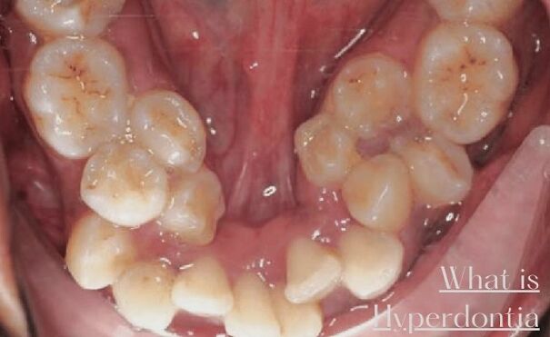 What-is-Hyperdontia-Causes-and-Treatment-646b9e08e408a.jpg