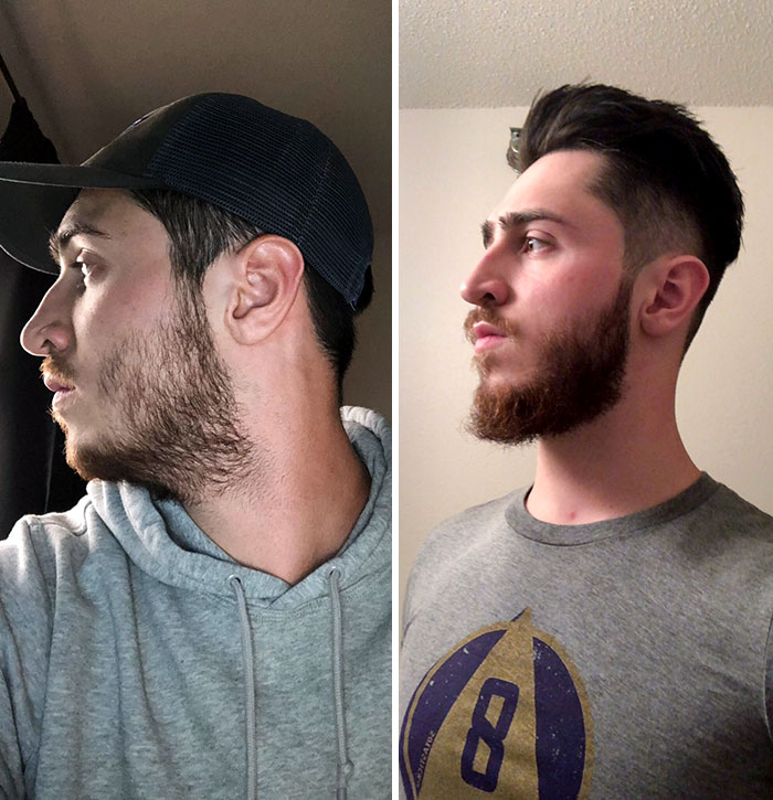 Patchy Beards Start To Look Less Patchy As You Let It Grow. 1 Month To A 5.5 Months