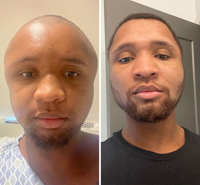 Had My Facial Reconstruction Surgery 2 Months Ago. Was Called Megamind, Ken Griffey Jr, Jimmy Nuetron, Etc. 8 Weeks Later And Feeling A Lot More Confident In How I Look