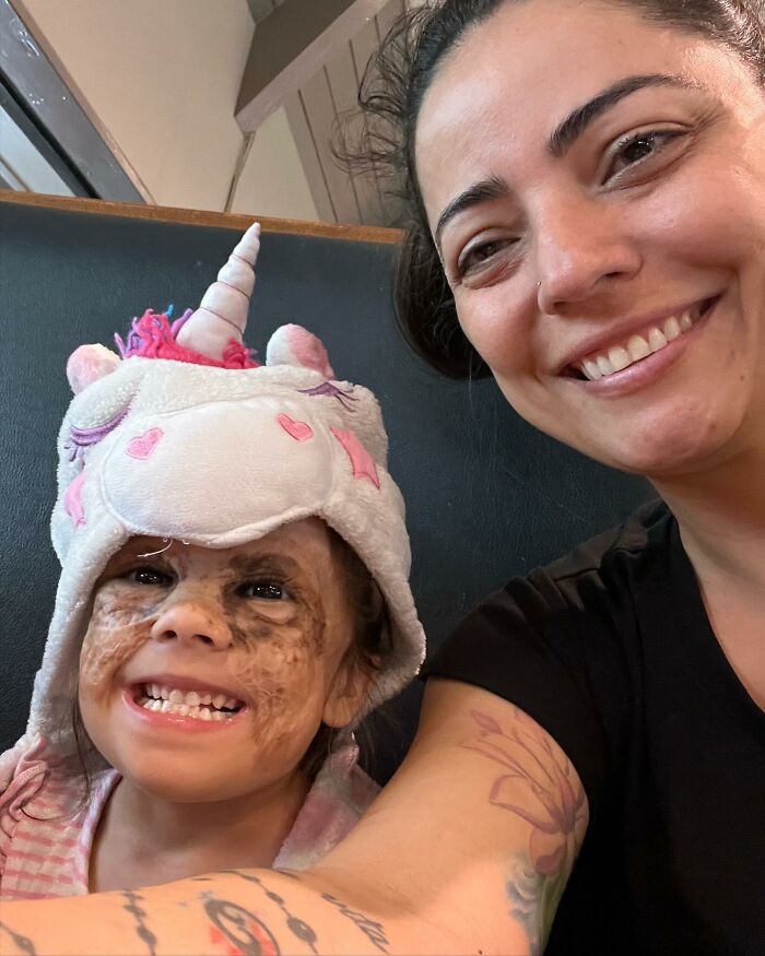 This 4-Year-Old Girl Has Undergone Multiple Surgeries To Get A Dangerous Birthmark Removed From Her Face