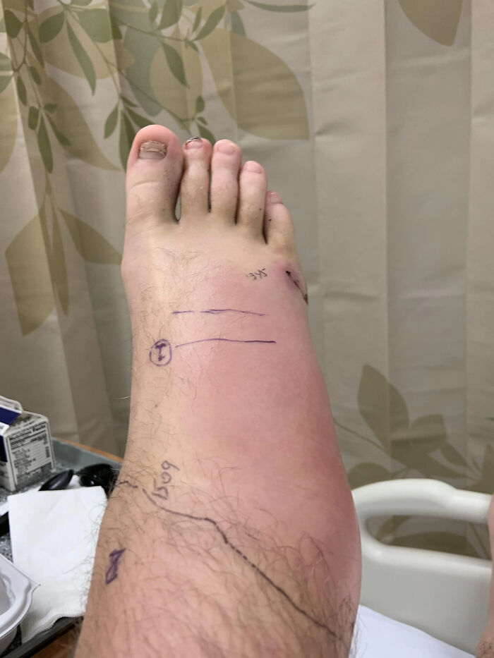 This Foot Two Days After A Rattlesnake Bite