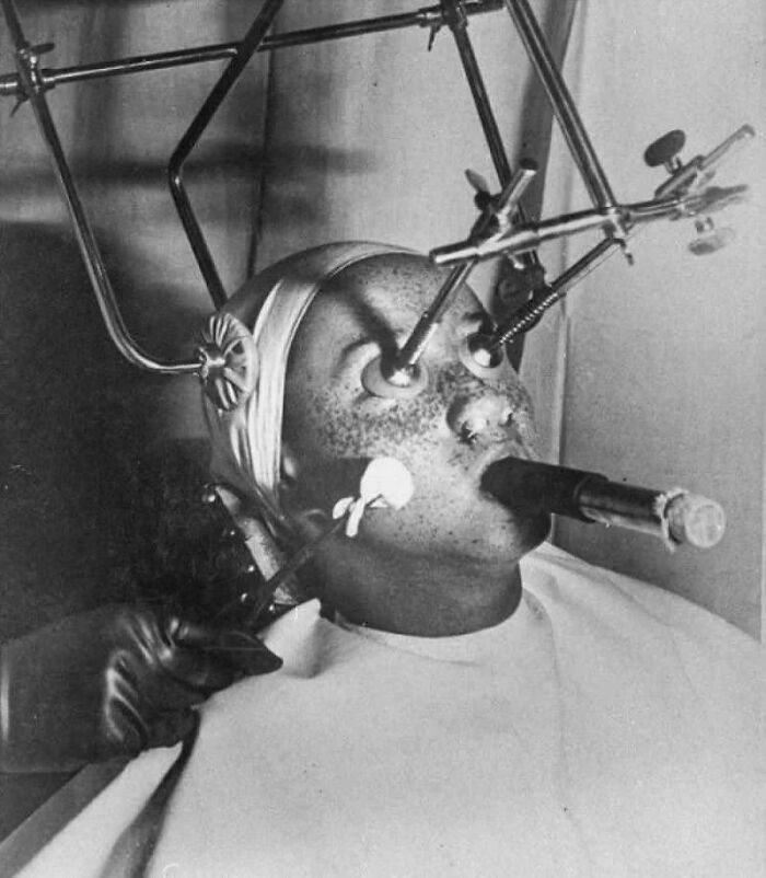 Freckles Removal Treatment From The 1930s