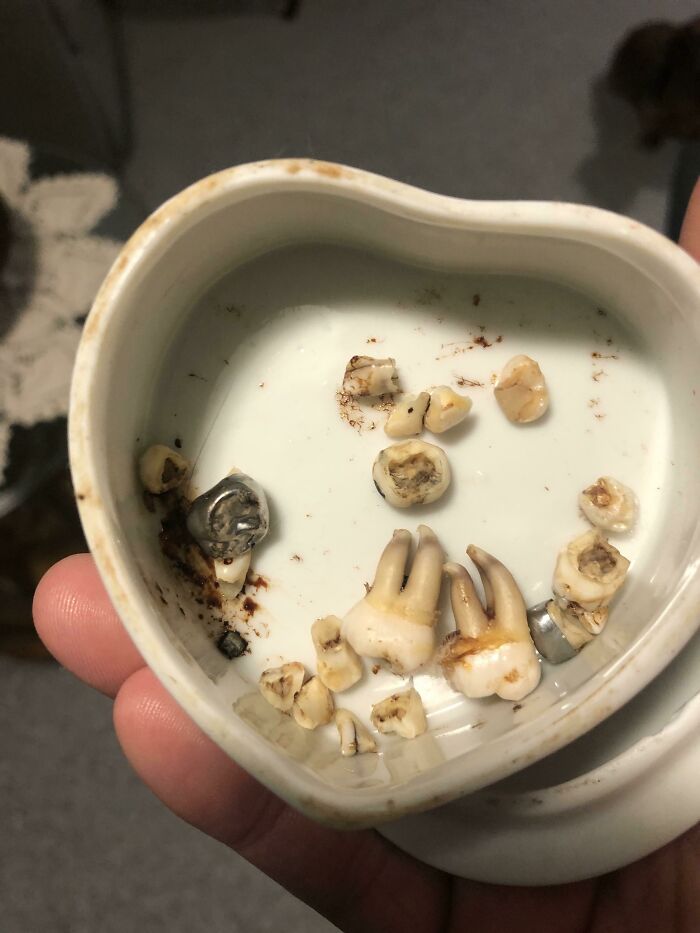 Found My Old Teeth When Visiting My Parents (I’m 33)