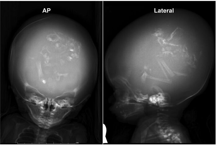 3 Gemelos parásitos en el cráneo de un bebé de 2 meses