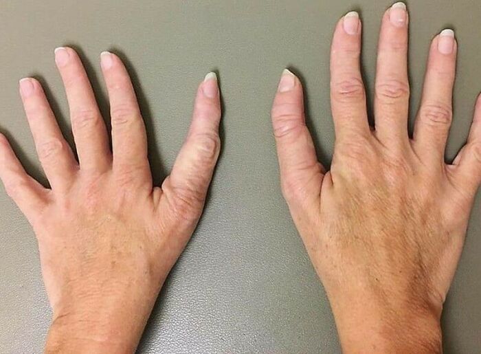 Triphalangeal Thumb (TPT) Is A Congenitalmalformation Where The Thumb Has Three Phalanges Instead Of Two