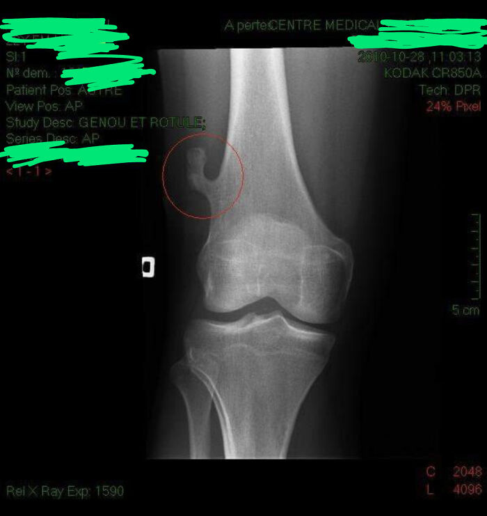 I Just Found My X-Ray From 2010. It Shows An Abnormal Bone Growth On My Right Femur That Has Since Been Surgically Removed