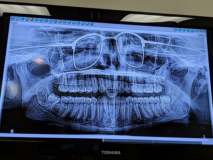 I Got A Panoramic X-Ray Of My Teeth The Other Day. The Dentist Forgot To Have Me Remove My Glasses