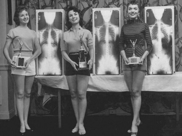 In The 1950s, There Was A Contest To Choose The Person With The Best Spine In An Orthopedic Conference In Chicago, USA. X-Rays Showed That These Three Women Won The Award For The Best Standing Position