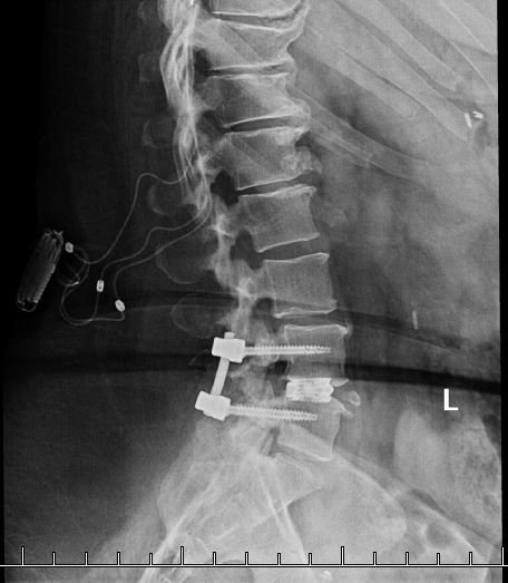 Back-x-ray-9-28-22-side-view-647e6d4547014.jpg
