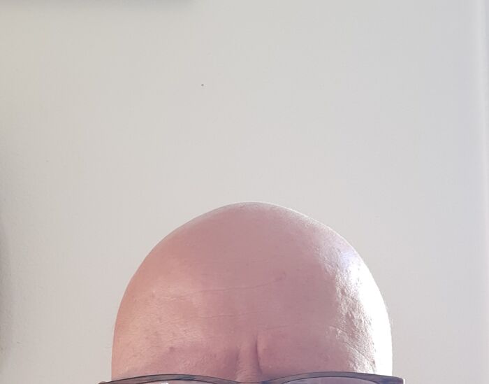 Hair? What Hair? All I Have Is This Di... Dome