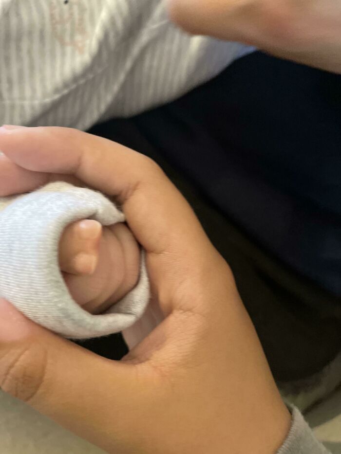 My Son Is Born With An Extra Thumb