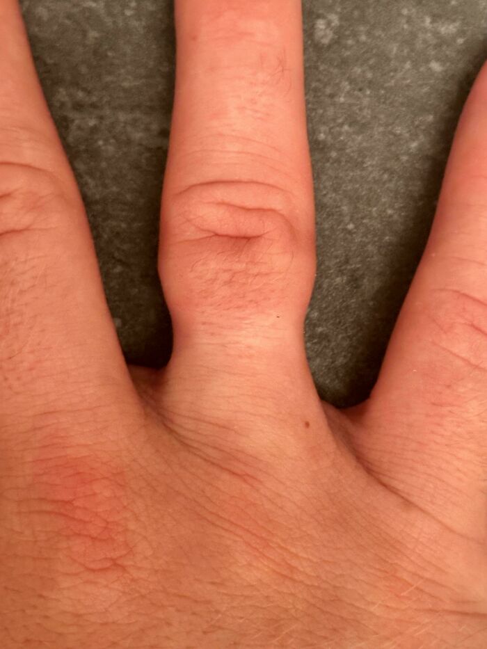 My Finger After I Finally Got A Ring Off That’s Been On For 2 1/2 Years Straight