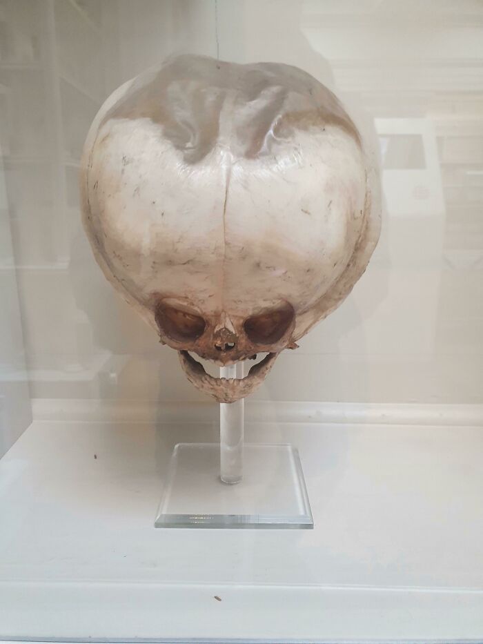 19th Century Hydrocephalic Foetus Skull, Royal College Of Surgeons Museum, Edinburgh