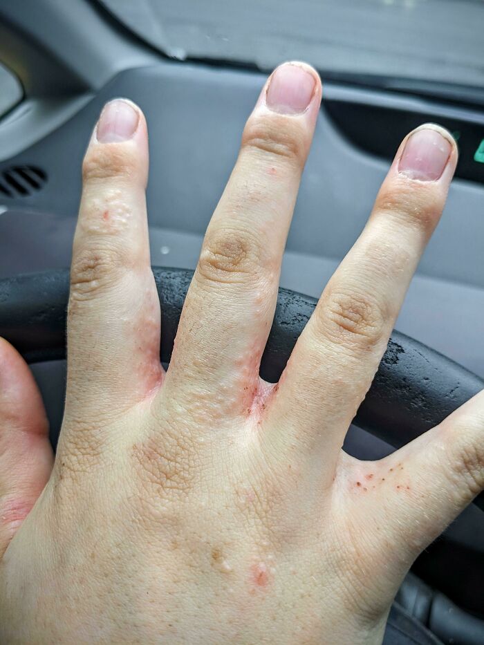 Poison Ivy Between My Fingers. I'm Considering Amputation At This Point