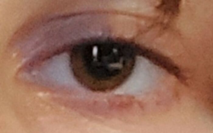Take This As A Warning, This Is What Ur Eye Will Look Like After 2 Weeks Of Shit Sleep