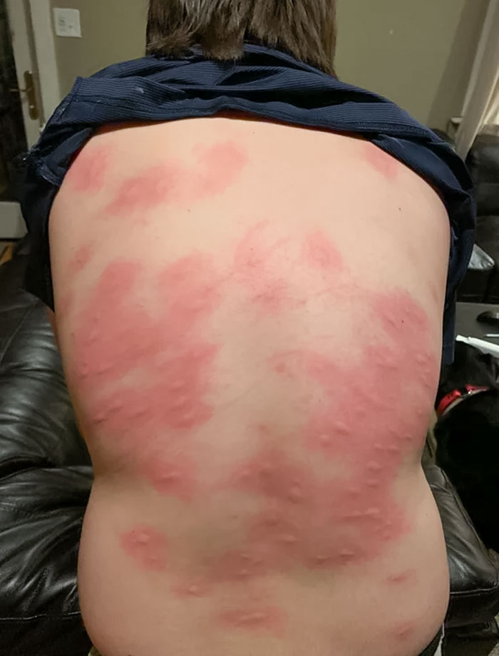 Ever Had So Many Mosquito Bites?