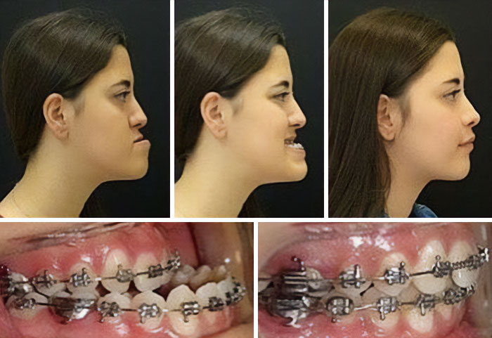 This Is How Great Surgery Has Evolved! Here You Can See The Result Of An Underbite Surgery And Jaw Positioning Correction
