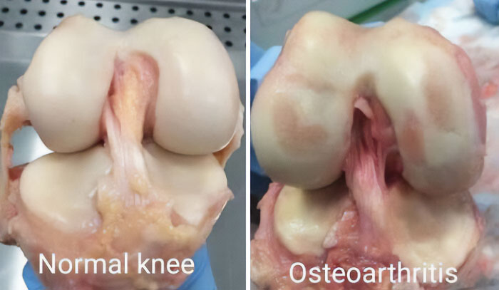 Normal Knee vs. Osteoarthritis