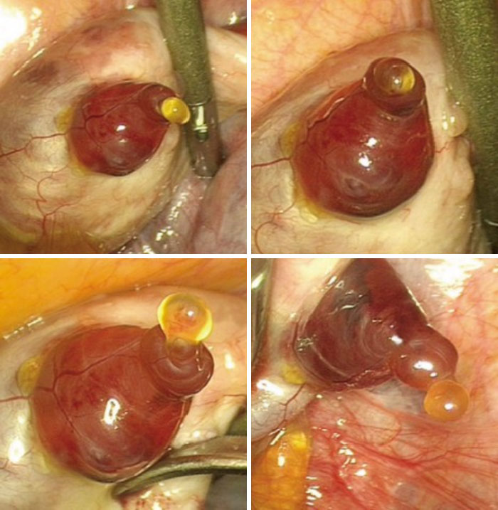 A Gynaecologist Captured A Human Egg Emerging From An Ovary While Performing A Hysterectomy