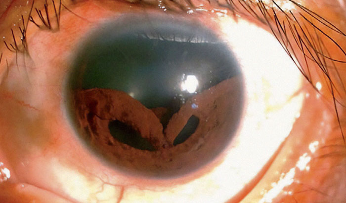 Bungee Cord To The Eye Caused Man's Iris To Collapse Into Multiple Deformed Pupils