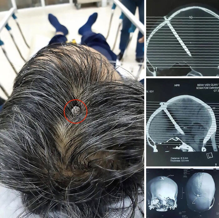 Man With 3-Inch Nail In Skull Goes To Hospital After Two Days… But Can’t Remember How It Got There!