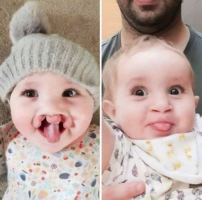 Beautiful Double Cleft And Palate Reconstruction