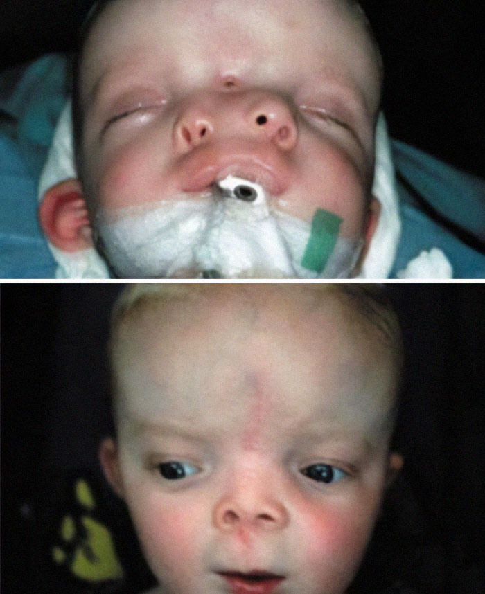 Antes y después de una operación de duplicación craneofacial