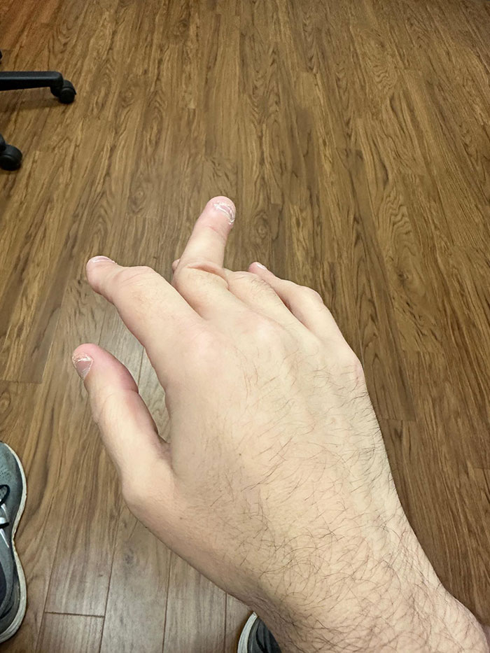 He conseguido dislocarme el dedo en 2 direcciones a la vez