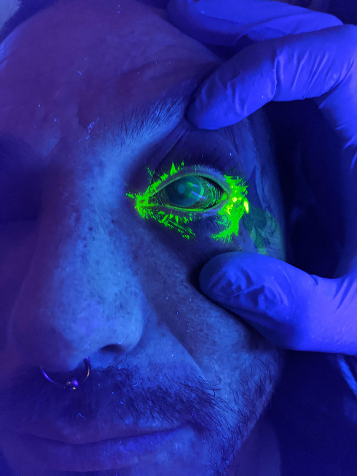 Fluorescent Eyedrops Show The Scratches On My Partner's Cornea After A Factory Accident. So That's Why It Hurts