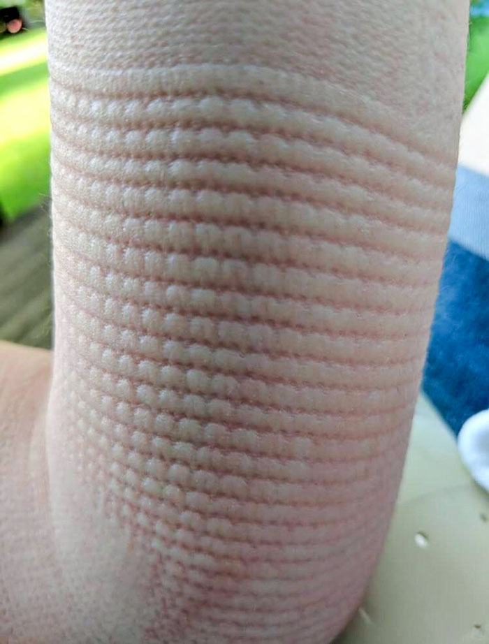 My Skin After I Took Off My Cast