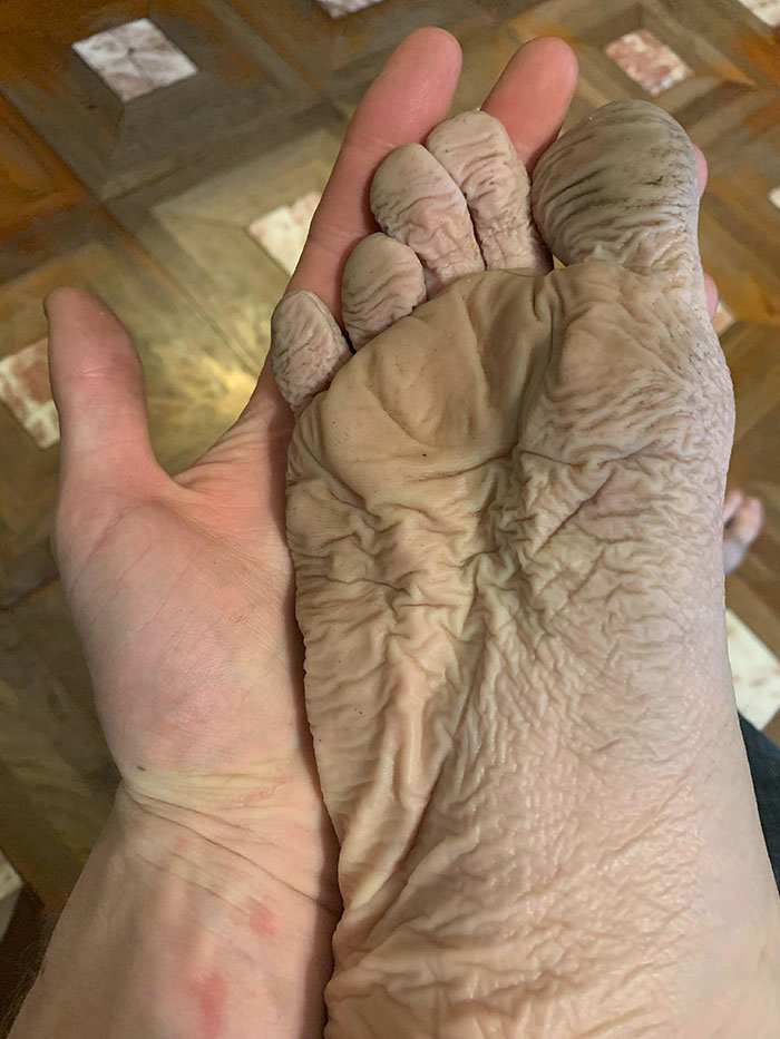 My Foot After Wearing A Wet Boot With A Hole In It For 10 Hours