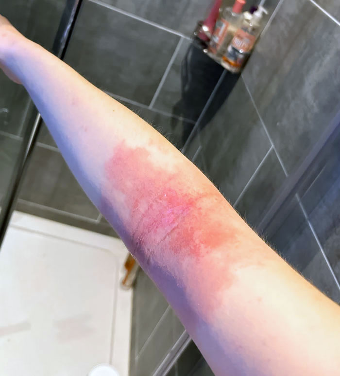 Eczema Seems To Be Infected Once Again, And I Need To Wait Until Monday To See A Doctor. It's As Painful As It Looks. Feels Like Ants Are Crawling Under My Skin