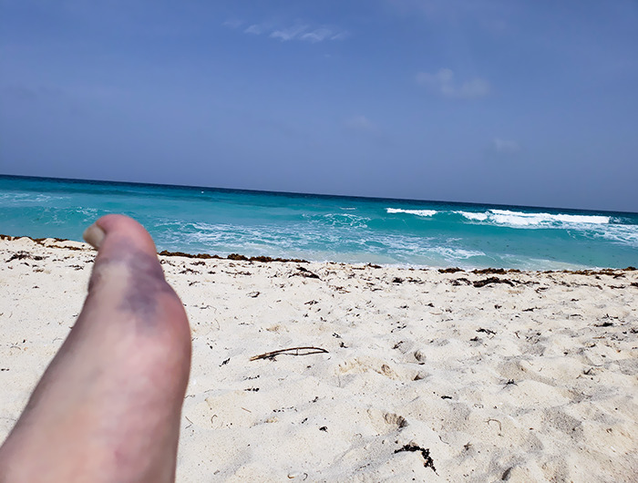Me rompí el pie en Cancún el primer día de mi luna de miel