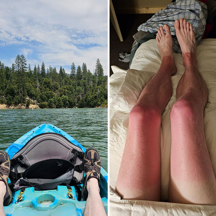 Se me olvidó ponerme protector solar en las piernas durante el viaje en canoa