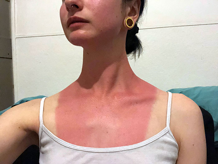 I Went Out On A Boat Without Sunscreen Today, And Now I Have What I Am Calling "The Bib Of Pain"