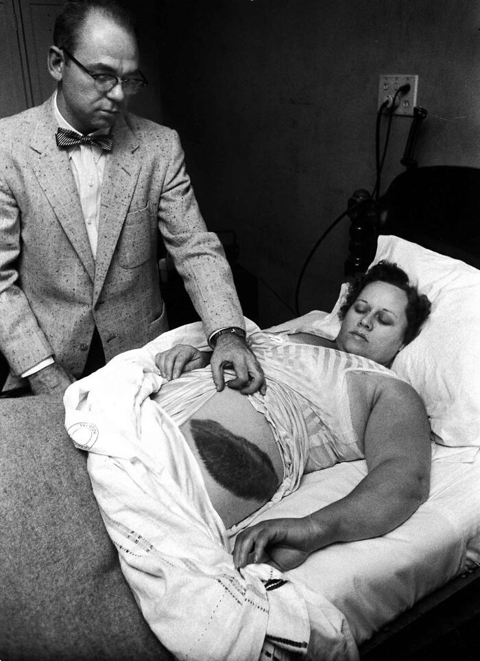 Ann Hodges Shows Off Her Bruise After Being Hit By A Meteorite, 1954