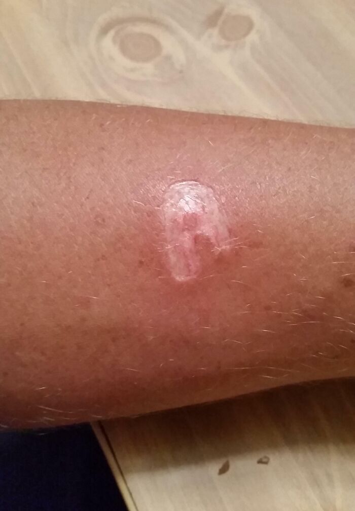 One Of My Drunk "Friends" Burnt Me With A Lighter Last Night