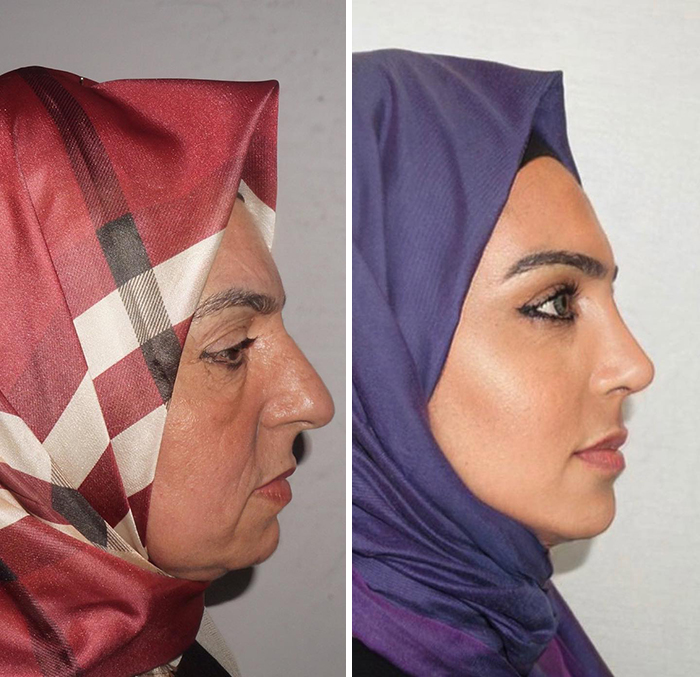 Before And After Photos From Turkish Plastic Surgery Clinic Have Left People Baffled